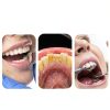 Dental Mirror MinToothpro Dual LED Light Removable Anti-Fog - Blue-6